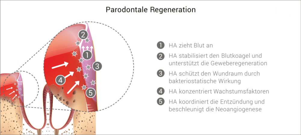 Chirurgische PA-Therapie