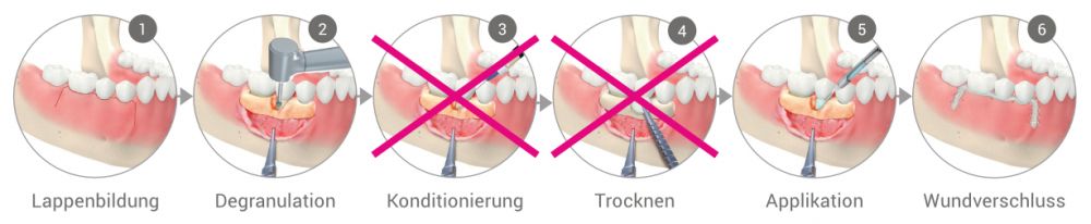 Chirurgische PA-Therapie