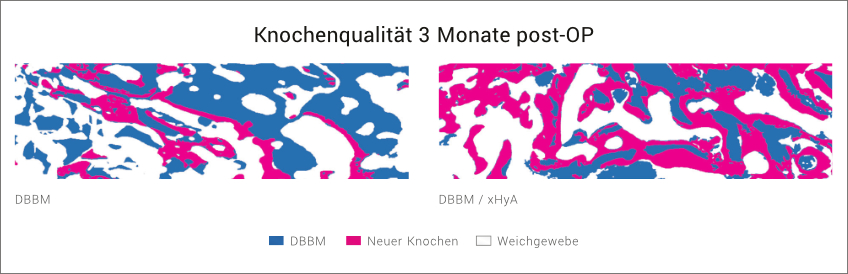 Knochenaugmentation