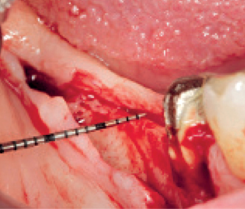 Knochenaugementation Case Report 1