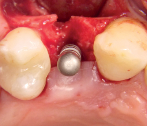 Knochenaugementation Case Report 1