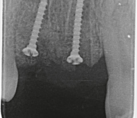 Regedent SMARTGRAFT Case Report 2